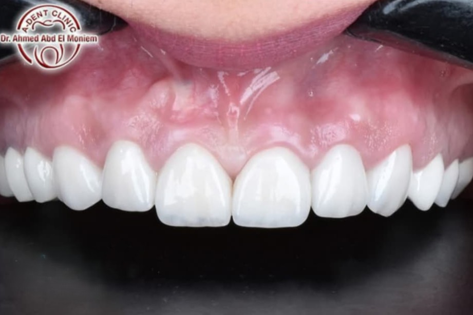 Before: case 22