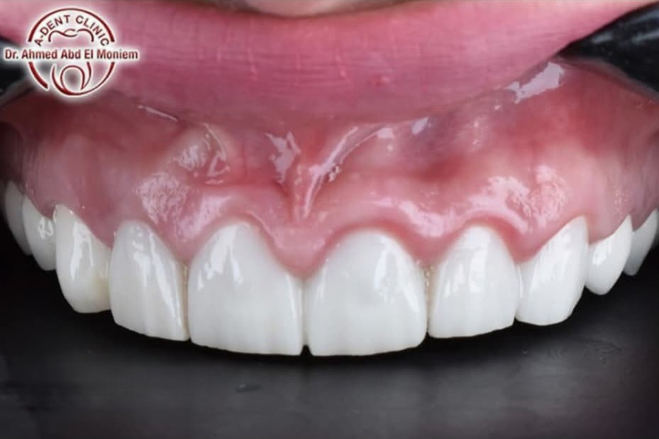 After: case 22