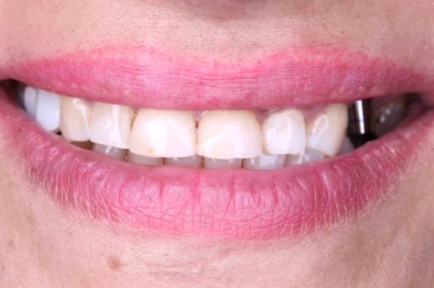 After: case 24