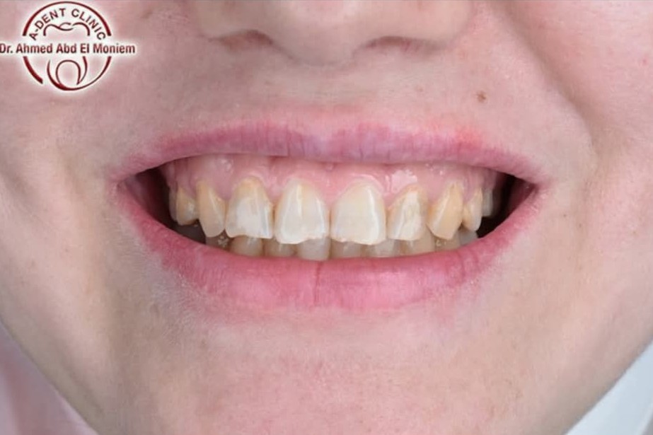 After: case 23